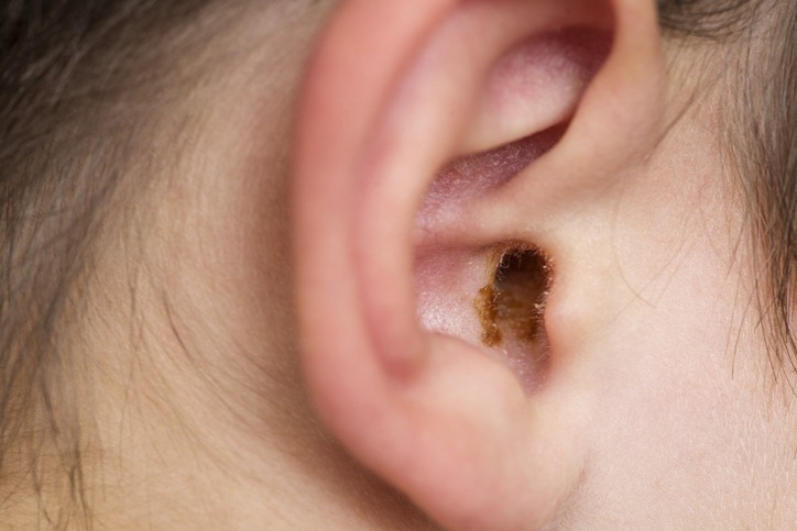 Earwax in the dirty ear of a child. Hole ear of human