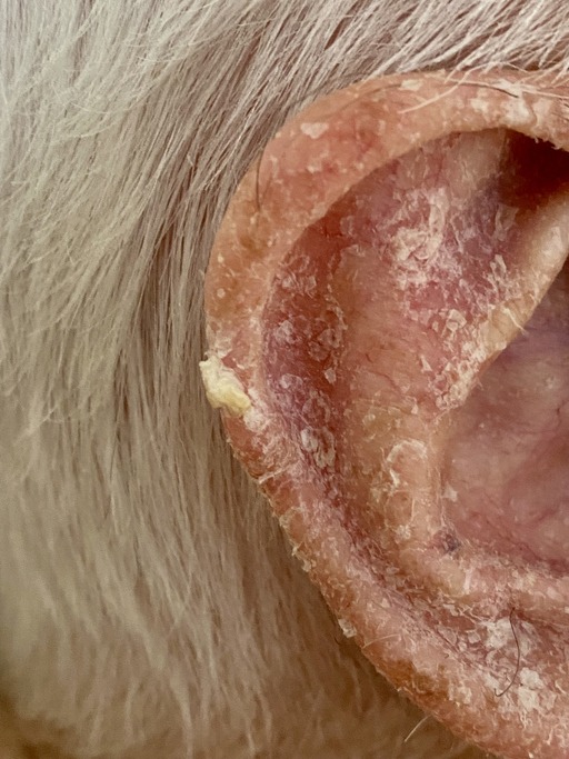 Hyperkeratosis on human ear helix